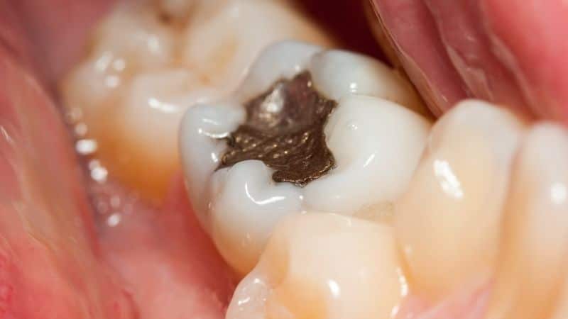 Photo of a tooth with an amalgam filling, a popular thing for dental work Colombia.